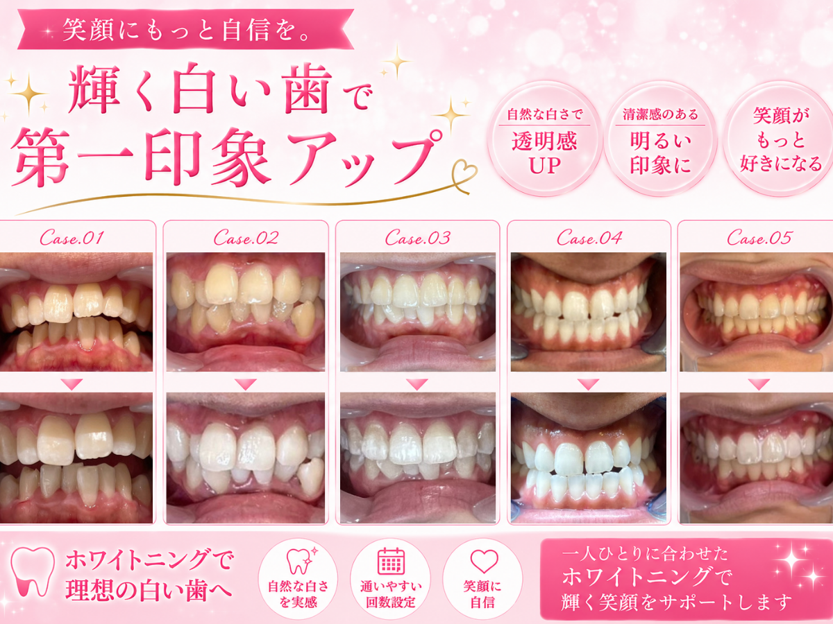 ホワイトニングの効果はどれくらい？